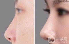 鼻部手術(shù)后吃什么消腫快