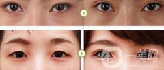 全切雙眼皮怎么護(hù)理 漂亮雙眼的秘密