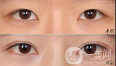 雙眼皮拆線多久用疤克