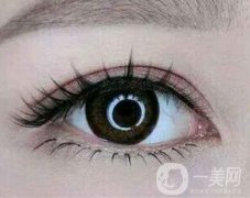 雙眼皮埋線前注意什么？