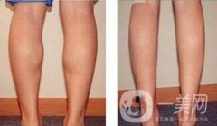 光纖溶脂瘦小腿果到底怎么樣