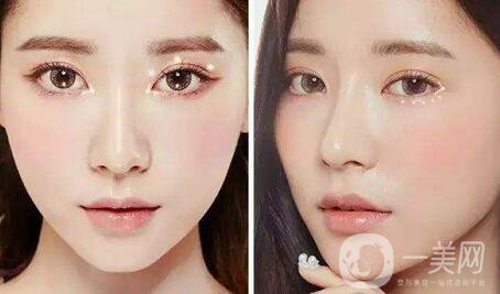雙眼皮拆線后怎么護理？