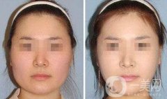 去頰脂墊瘦臉術(shù)后護(hù)理怎么做？
