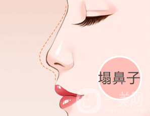 假體隆鼻手術之后多久可以修復