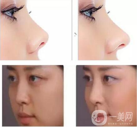 鼻小柱延長(zhǎng)恢復(fù)過程是怎樣的