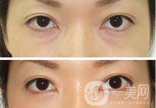 激光去眼袋手術(shù)后如何護理 要注意些什么