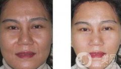 廈門做電波拉皮除皺多少錢