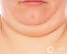 有雙下巴了怎么辦呢?去雙下巴的方法有哪些呢？