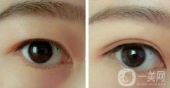 北京割雙眼皮的價格是多少錢