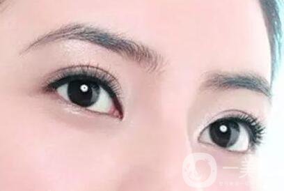 割雙眼皮痕跡多久消失？