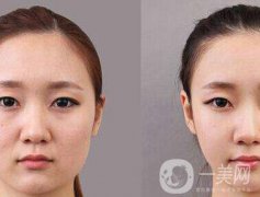 顴骨手術(shù)多長時間恢復(fù)？