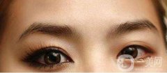 上海開眼角手術(shù)過程是怎樣的呢?