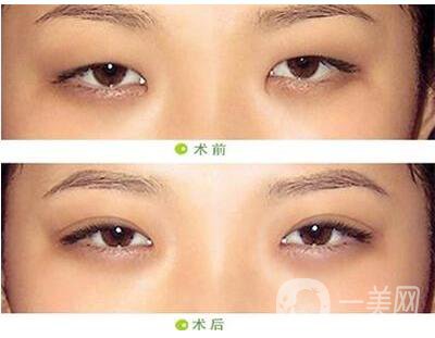 開眼角,開眼角手術(shù)過程,上海開眼角手術(shù)過程