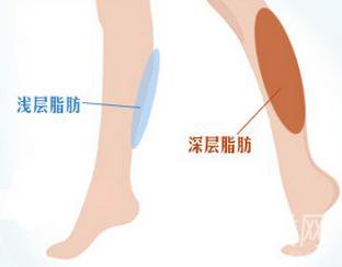 小腿吸脂手術(shù)后多久會*變瘦