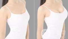 長(zhǎng)沙自體脂肪隆胸手術(shù)多少錢