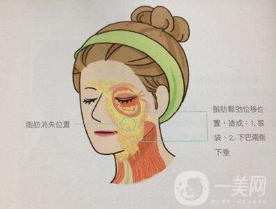 電波拉皮除皺*果好嗎？