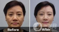 南京做電波拉皮手術(shù)價(jià)錢多少