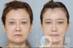 深圳埋線臉部提升價(jià)格多少