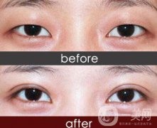 重慶埋線割雙眼皮多少錢