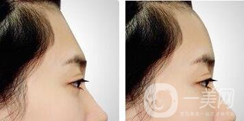 上海玻尿酸豐額頭的價格詳解