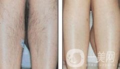 北京激光脫毛的價(jià)格到底是多少