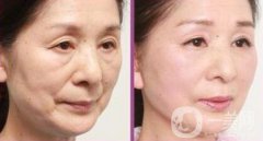 拉皮怎樣做？拉皮果有哪些？