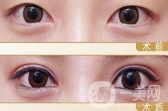 割雙眼皮冷敷作用是什么