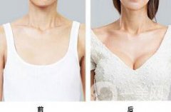 假體豐胸的*性高嗎