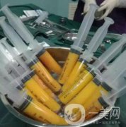 自體脂肪填充隆胸果怎么樣