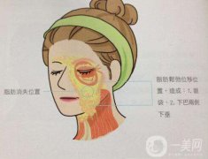 成都電波拉皮手術(shù)一般多少錢?