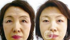 電波拉皮有副作用嗎