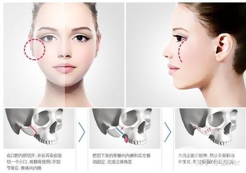 顴骨磨削術削哪里 術后護理介紹 2