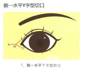 什么是開眼角手術(shù) 術(shù)后如何護理 2