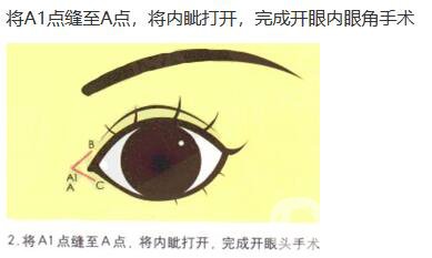 什么是開眼角手術(shù) 術(shù)后如何護理 3