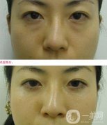 電波拉皮去眼袋果怎么樣？