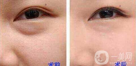 電波拉皮去眼袋*果怎么樣？