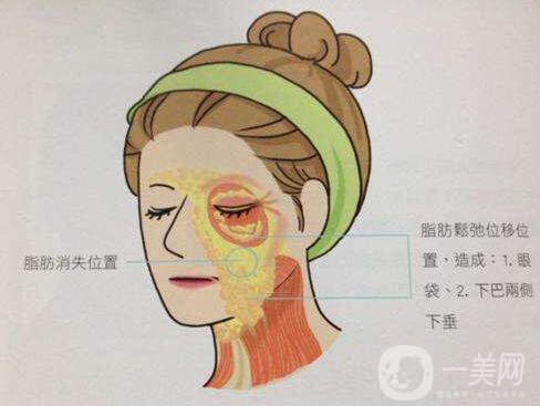 冰電波拉皮好嗎？冰電波拉皮優(yōu)勢(shì)！