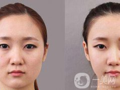 顴骨肉怎么消？怎么縮小顴骨？