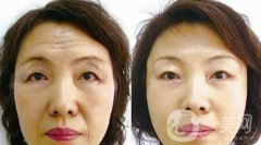 成都做個(gè)拉皮多少錢(qián)