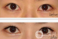 廣州開(kāi)眼角的費(fèi)用是多少