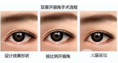 開眼角多少錢 開眼角增生怎么辦