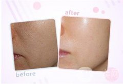 上海玻尿酸豐面頰價格是多少錢