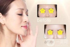 玻尿酸豐太陽穴多少錢？