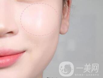 北京自體脂肪豐蘋(píng)果肌手術(shù)一般多少錢(qián)