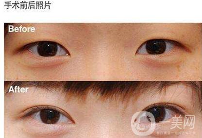 開(kāi)眼角,開(kāi)眼角優(yōu)勢(shì),哪里開(kāi)眼角好