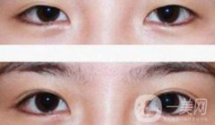 割雙眼皮為什么會成肉條