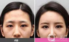 廣東自體脂肪填充淚溝多少錢？