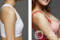 上海假體隆胸的價(jià)格高嗎？要多少錢