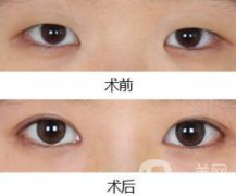 做開眼角手術(shù)前后注意事項具體是什么
