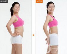 激光溶脂減肥術(shù)后還會(huì)反彈嗎